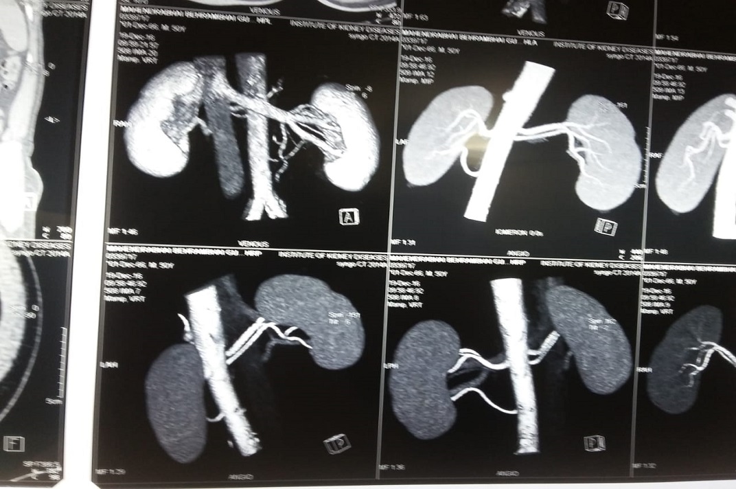 Kidney imaging scan used for urological diagnosis and treatment planning