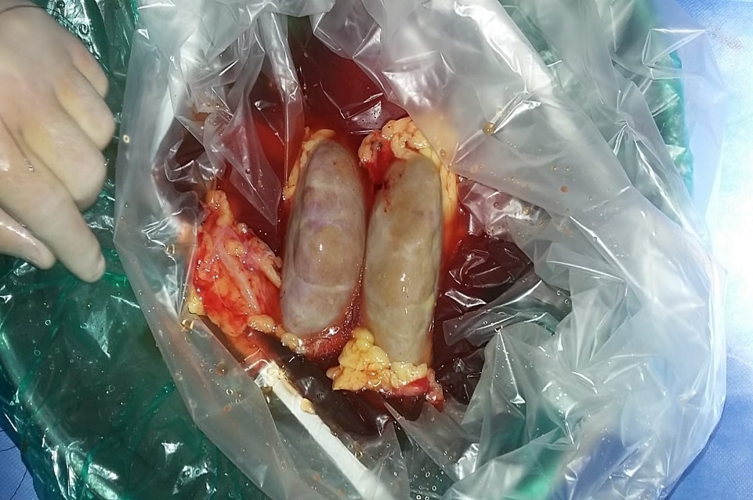 Surgical specimens prepared for clinical examination following a kidney procedure