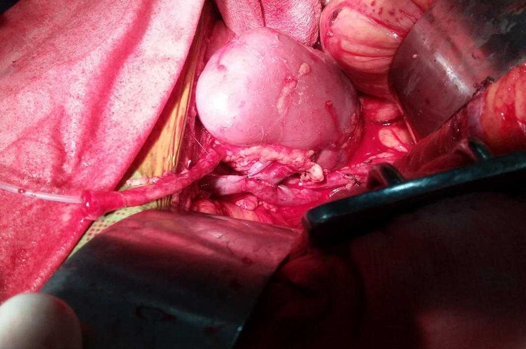 Urological surgical procedure performed by a medical team