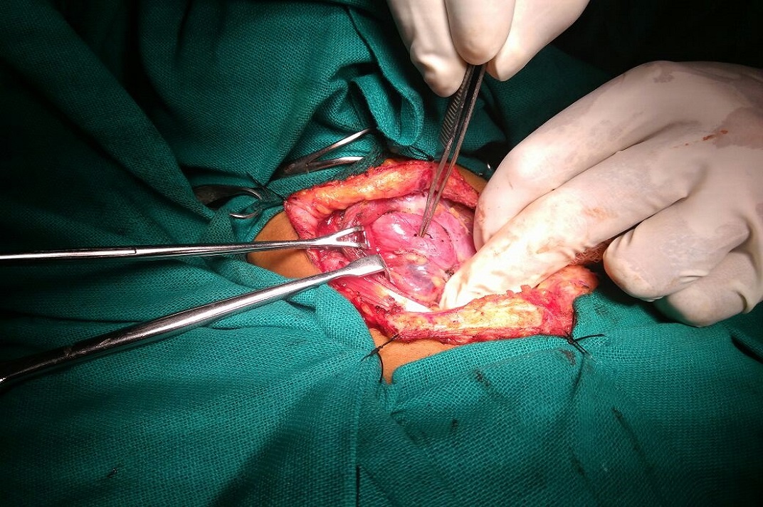 Urological surgical procedure performed by a medical team